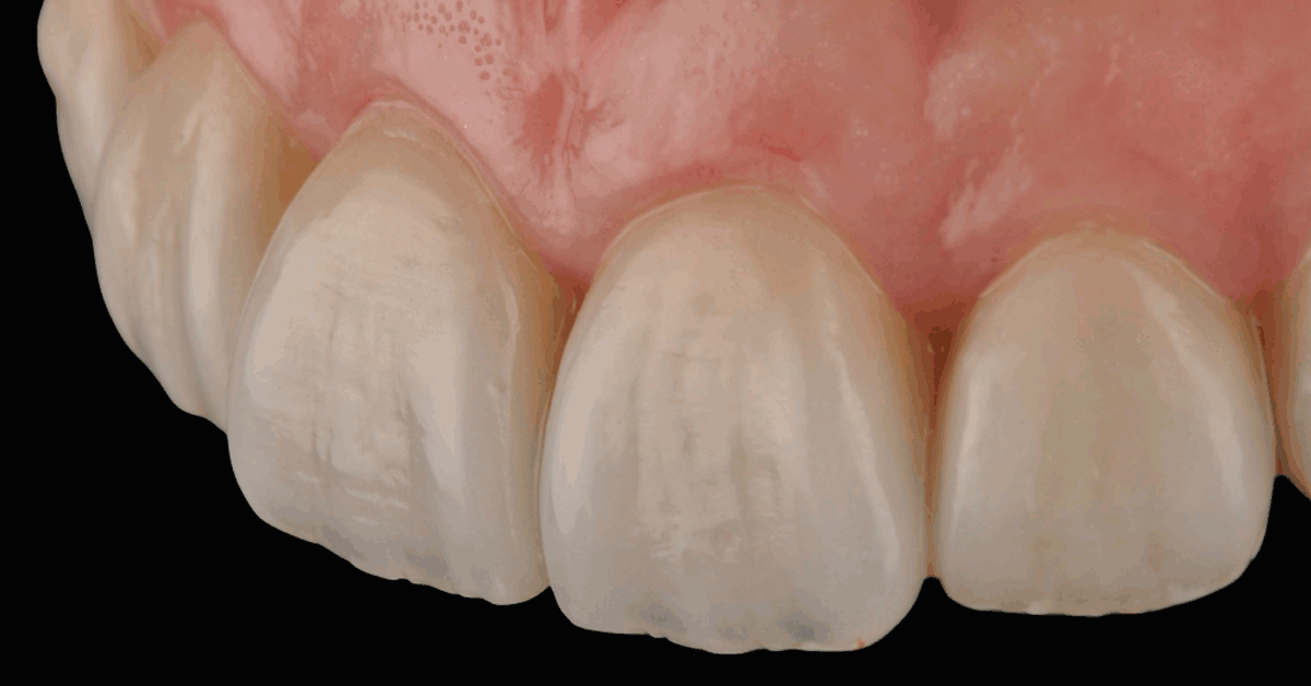 D'Email et D'Ivoire - Laboratoire de Prothèse dentaire - Intégrer les dyschromies