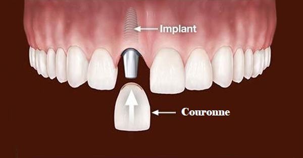 D'Email et D'Ivoire - Laboratoire de Prothèse dentaire - Implants