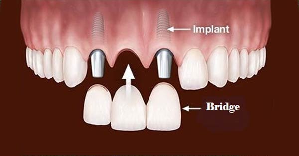 D'Email et D'Ivoire - Laboratoire de Prothèse dentaire - Implants