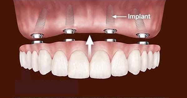 D'Email et D'Ivoire - Laboratoire de Prothèse dentaire - Implants