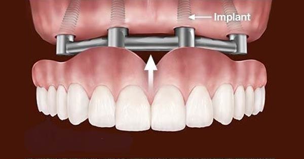 D'Email et D'Ivoire - Laboratoire de Prothèse dentaire - Implants