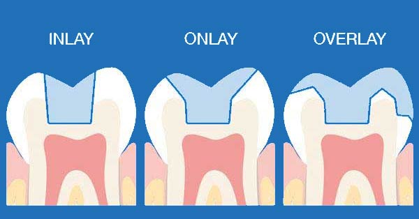 D'Email et D'Ivoire - Laboratoire de Prothèse dentaire - Onlay / Inlay
