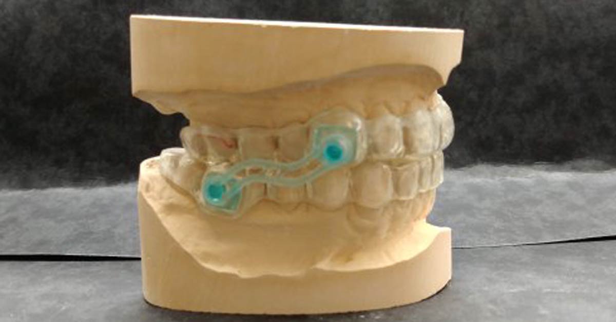 D'Email et D'Ivoire - Laboratoire de Prothèse dentaire - Gouttières  protège-dents